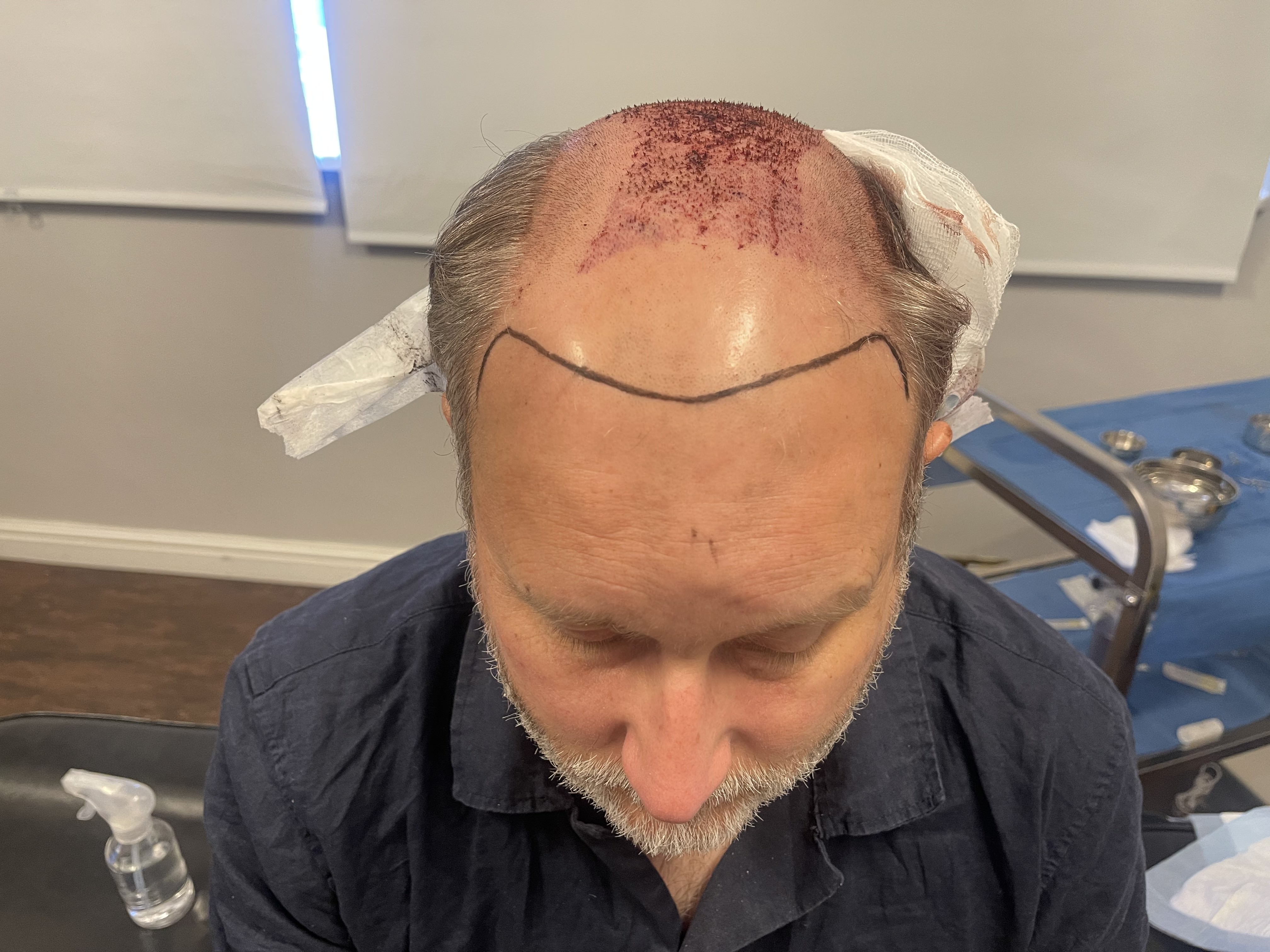 Norwood 7 hair transplant — Colin result photo 4